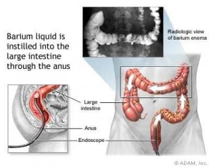 Barium Enema